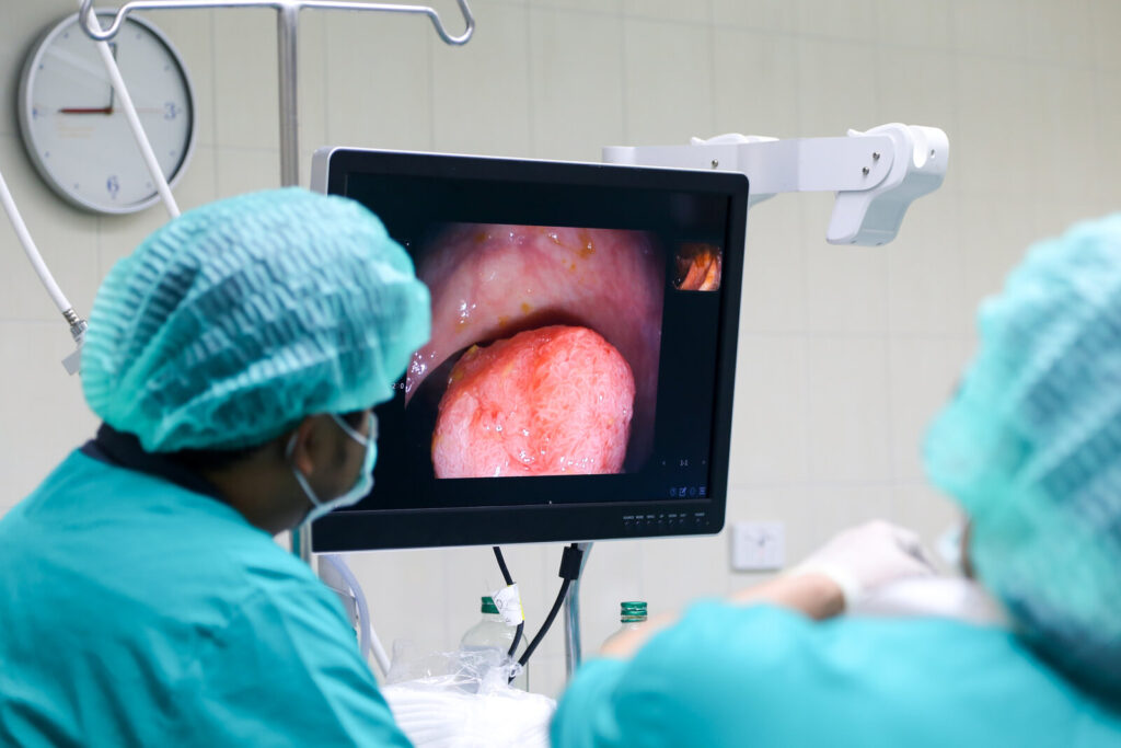 Finding it early Clinicians in scrubs watching a colonoscopy image on a monitor