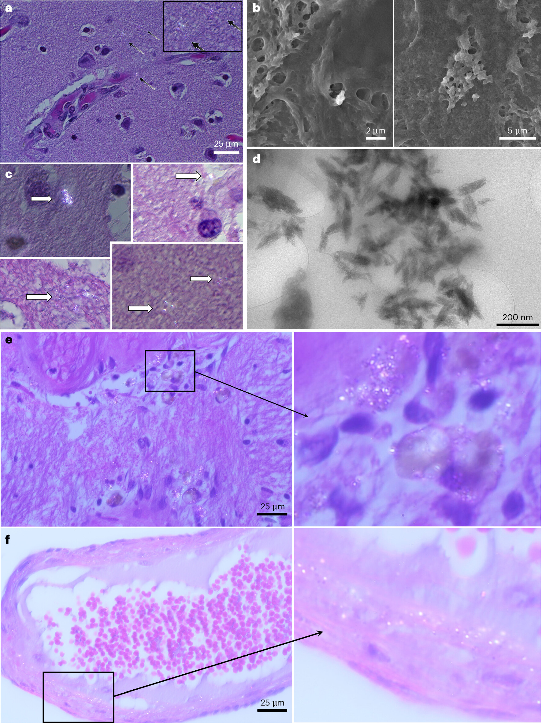 Microscope images from the study showing tiny bright specks and flake-like particles in human brain tissue